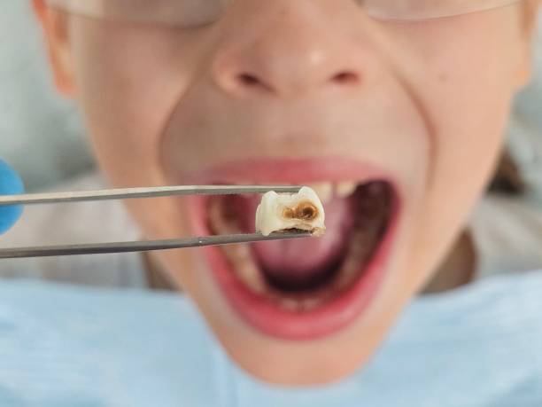 Best Emergency Dental Care for Broken or Chipped Teeth in Indian Hills, CO